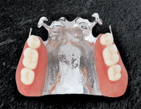 阿倍野、天王寺の歯医者、佐々木歯科の金属床義歯イメージ