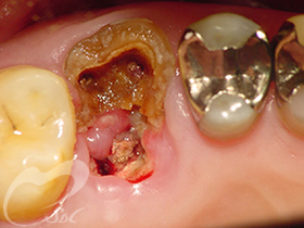 虫歯の末期状態
