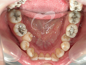 1：治療前（上下の歯）