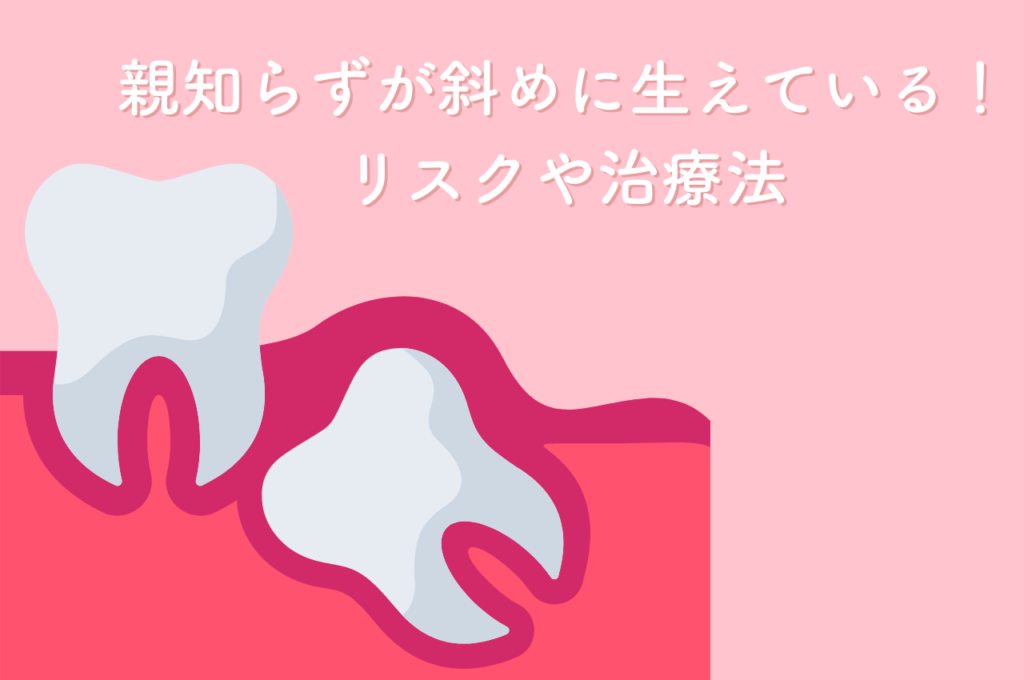 親知らずが斜めに生えている時の抜歯!リスクや治療法を解説 阿倍野区の(医)佐々木歯科医院^ ^